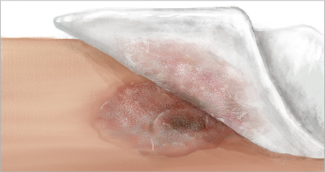 Daily dressing change