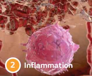 Inflammation