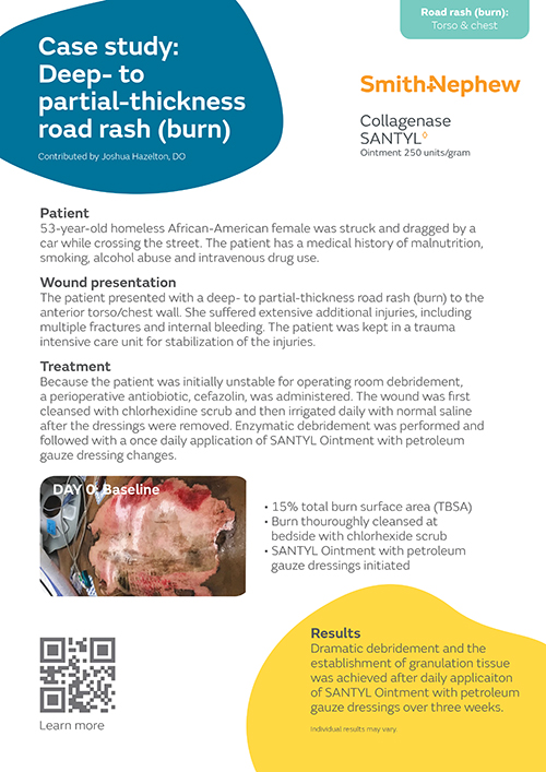 Deep- to partial-thickness road rash (burn)