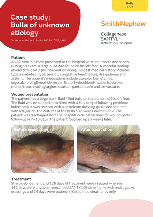 Bulla of unknown etiology