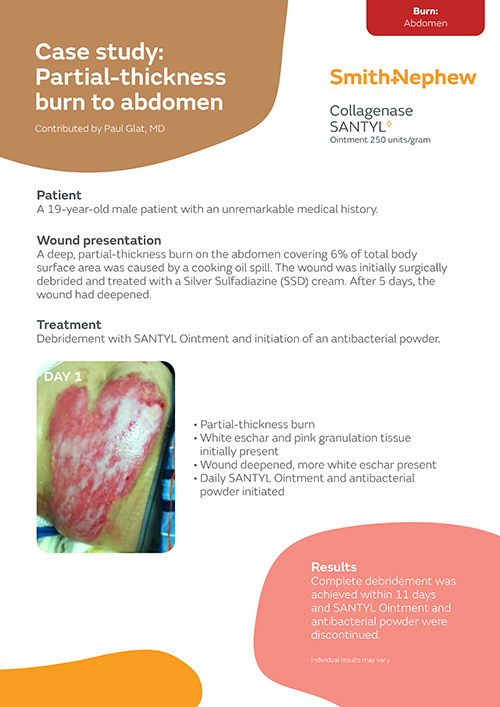 Partial-thickness burn to abdomen