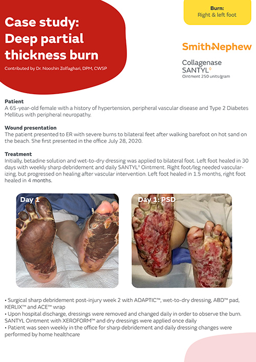 Deep partial thickness burn